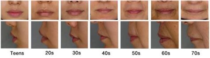 Do lips thin with age?