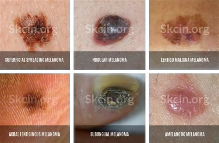 Is melanoma always dark?