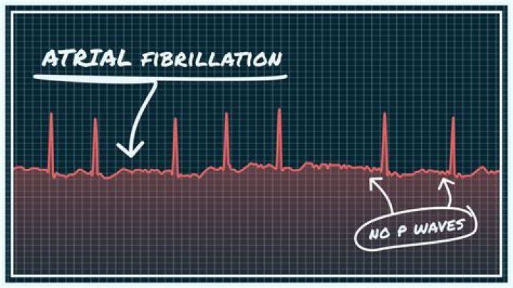What does AFib feel like at night?