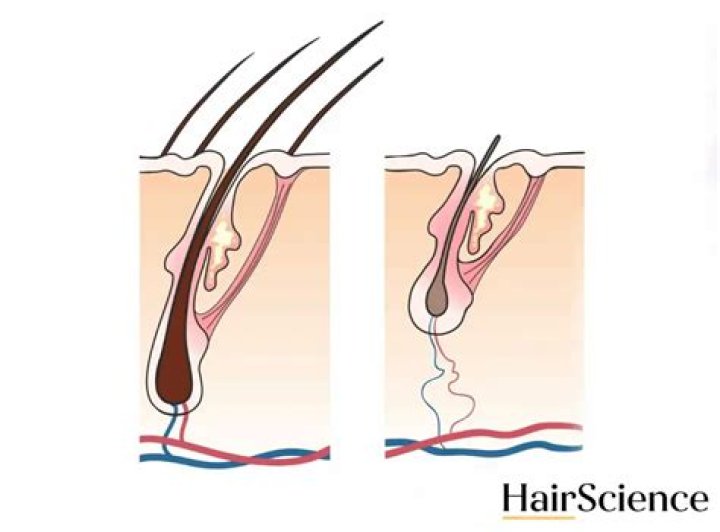 What is a vellus hair cyst?